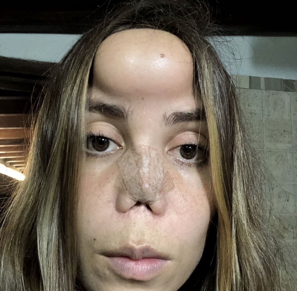 Months later, visible scarring across forehead, brow and nose