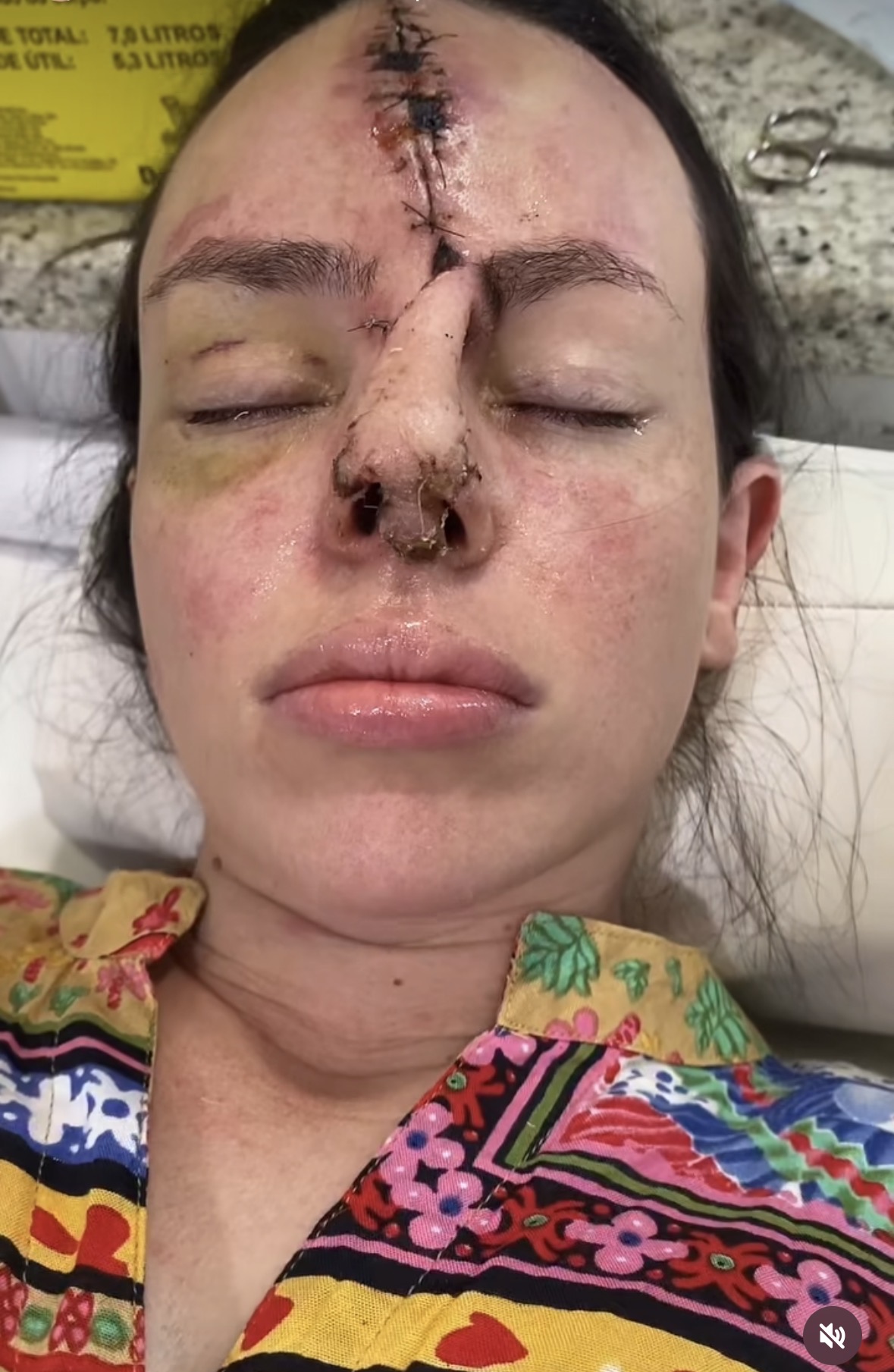 Mid reconstruction, forehead flap pedicle still attached