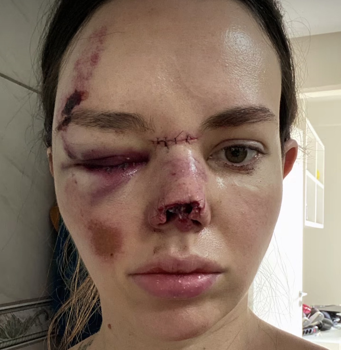 Early post op bruising and sutures from reconstructive surgery