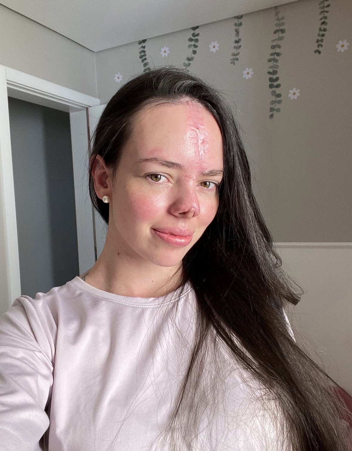 Healed, pink forehead scar still visible after reconstruction